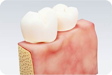 診療案内_歯周病